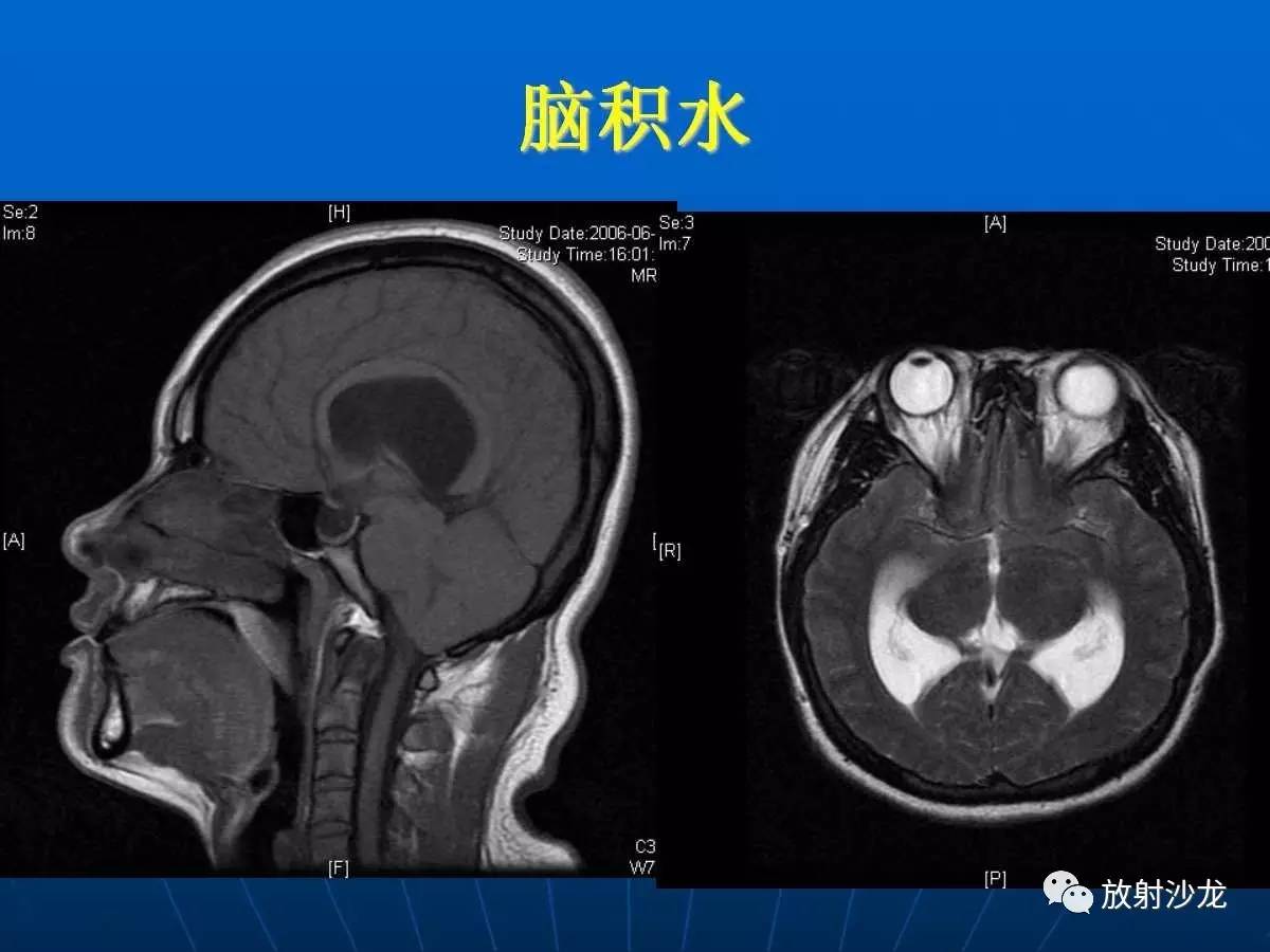 基础必备脑部磁共振呈像