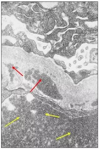 肾内病理图解:有形结构沉积肾小球病