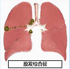 原发性肺结核病的病理特征是原发综合征(primary complex)形成