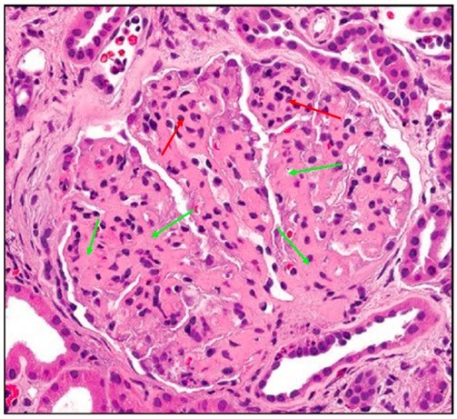 肾小球系膜基质图片