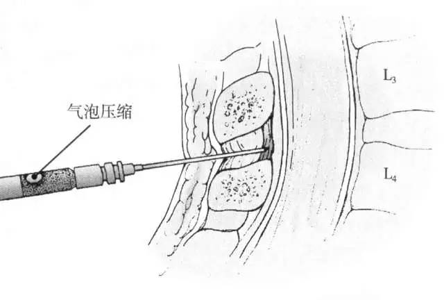 椎管内注射图片