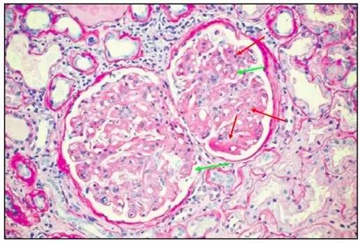 红色箭头:肾小球系膜区基质明显增多,系膜增宽,系膜细胞未见明显增生
