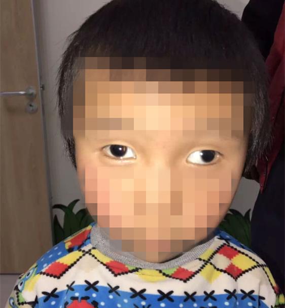 今年5岁的刘兴,患有先天性斜视,不仅 眼睛的外观和别的孩子不一样