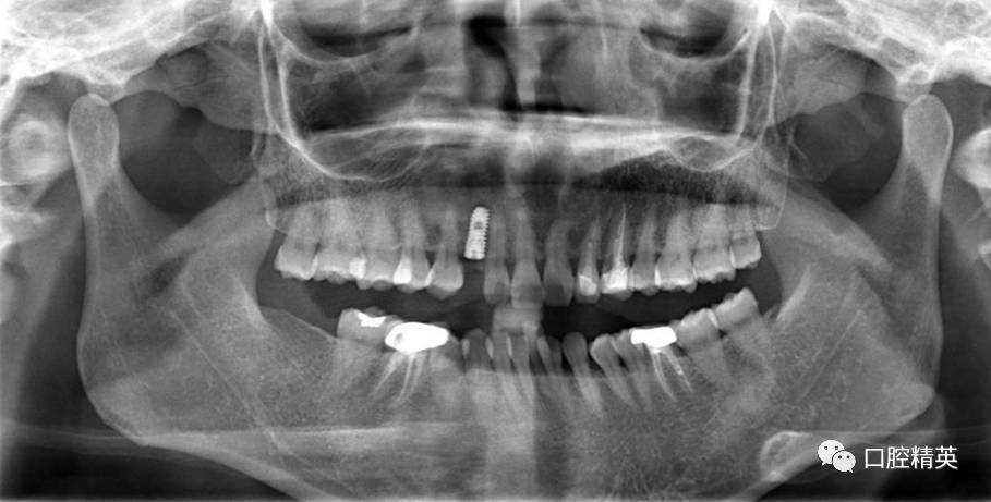 牙槽骨骨折图片图片