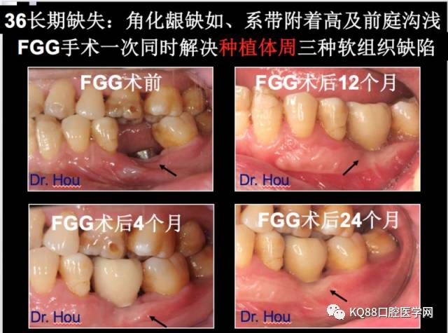 游离龈瓣的获取及供瓣区的处理技巧; ii 受瓣区的制备技巧; 2