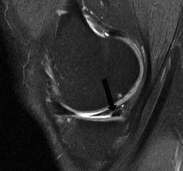 骨哥阅片课堂:正常 异常半月板 mri 解读