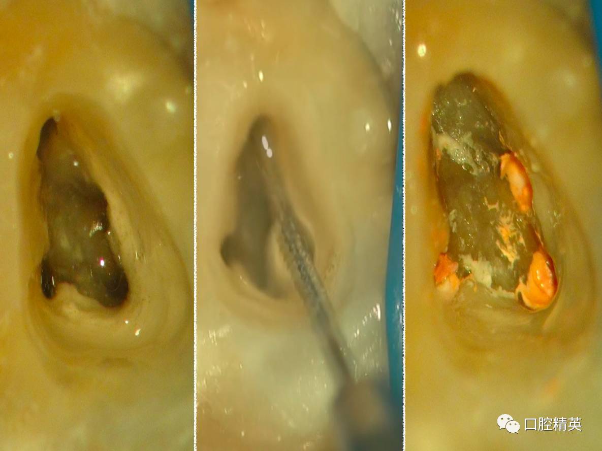 【經典病例】下7根管治療到修復