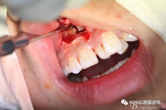 阻生齿拔牙过程图片