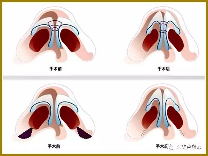 达拉斯精细综合鼻整形与临床案例示教研修班