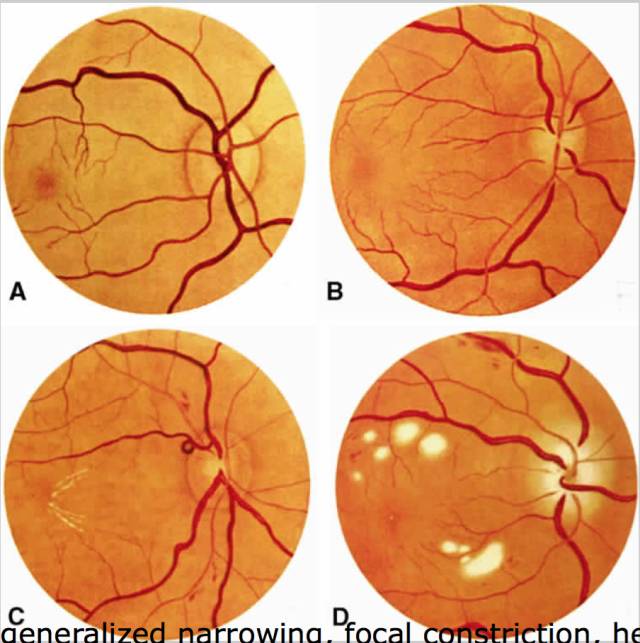 高血压病的眼底表现可分成三个部分:高血压性视网膜病变,高血压性脉络