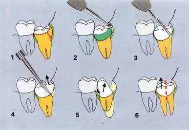 拔牙过程图解图片