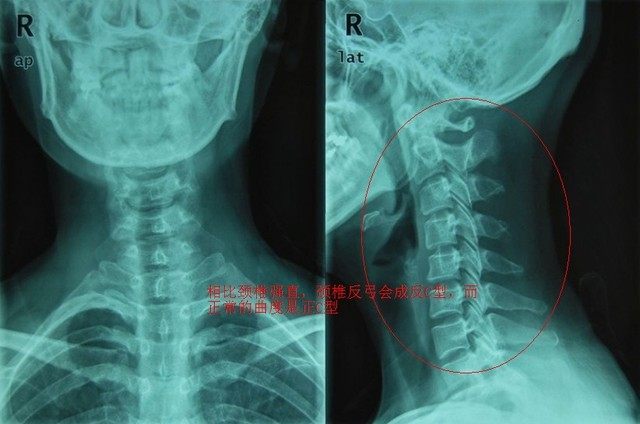 10年骨科专家答疑颈椎生理曲度变直是什么鬼严重不