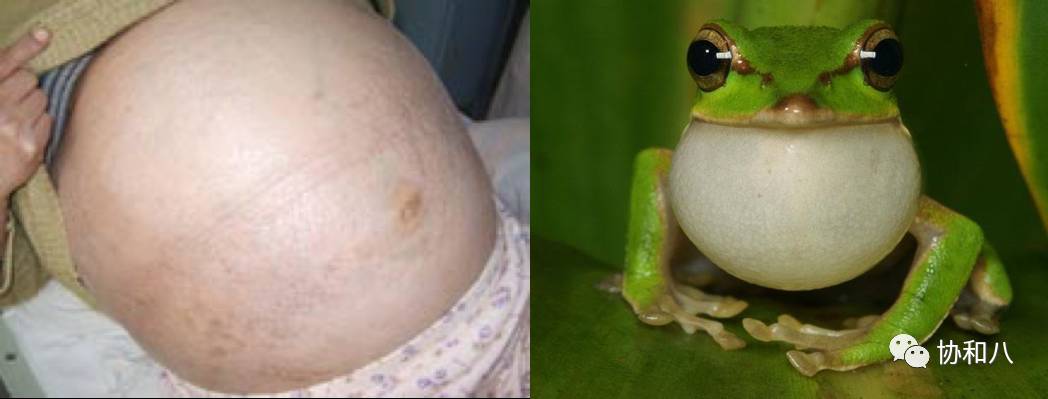 蛙腹状肚子图片