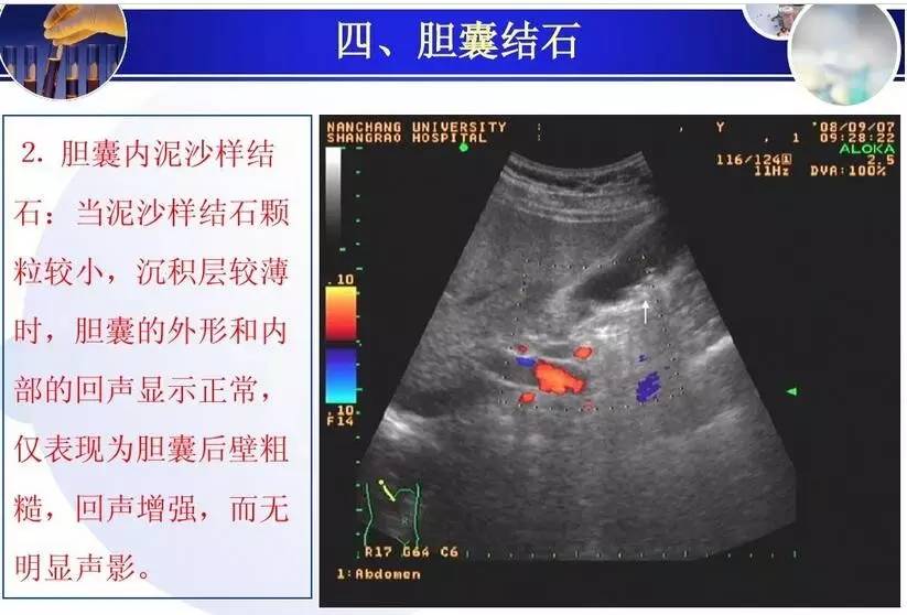 胆囊和胆道的超声诊断