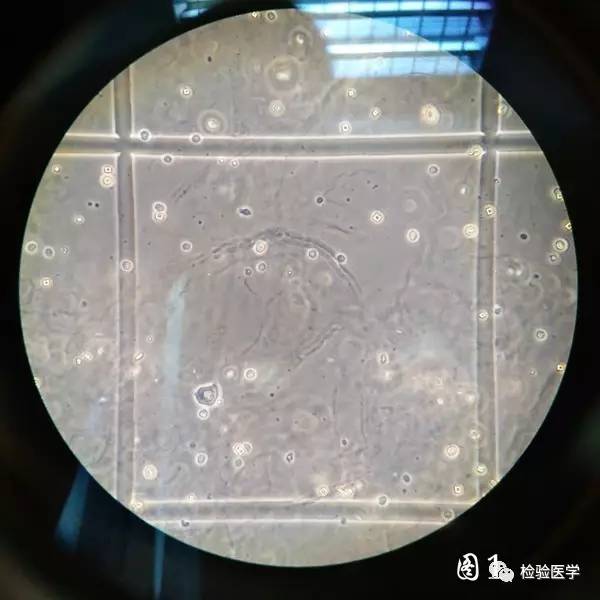 显微镜下的尿液图片