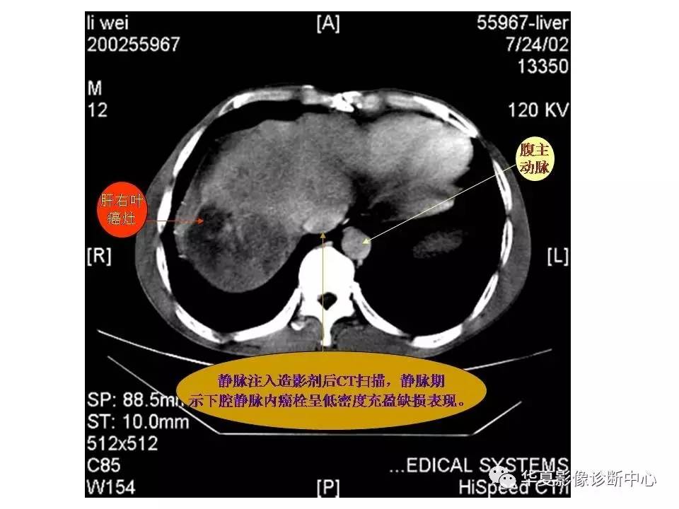 腹主动脉ct位置图图片