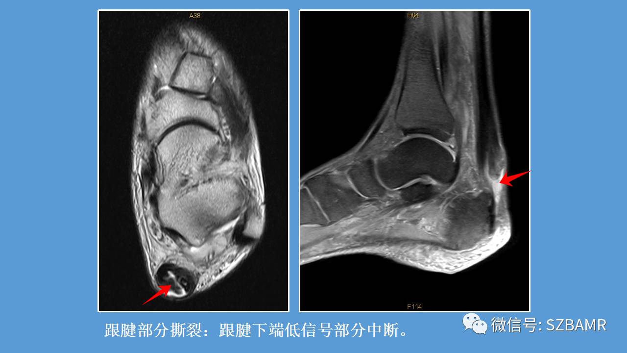 跟腱断裂磁共振图像图片