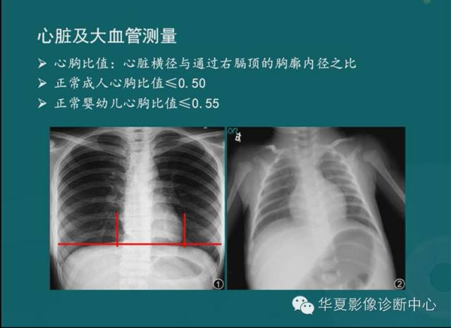 心血管影像学解剖的正常与异常