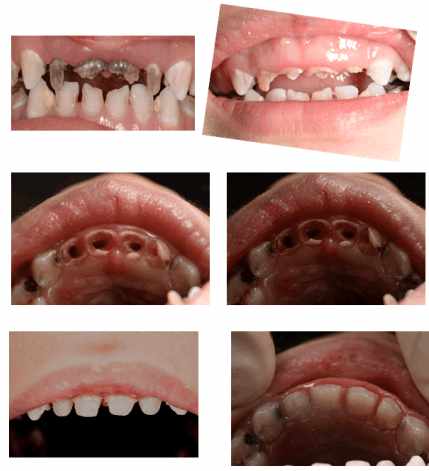 儿童龋齿上图,小孩的牙齿基本上都是龋齿,四颗门牙和下颌四颗大牙,被