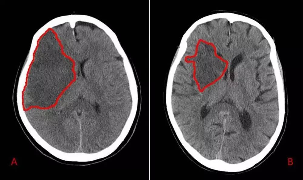 大脑ct图片,红圈处为中风区域 (图片来源:brainpictures )