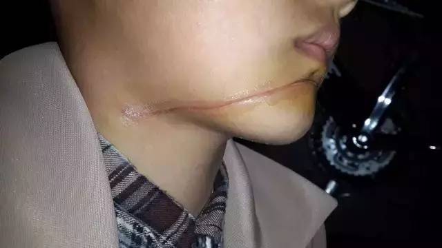 恐怖山东9岁男孩惨遭割脸这个元凶我们经常见