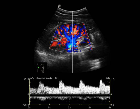 在cfm成像模式下,經腎臟冠狀切面掃查,可見腎血管樹的彩色血流圖,可以