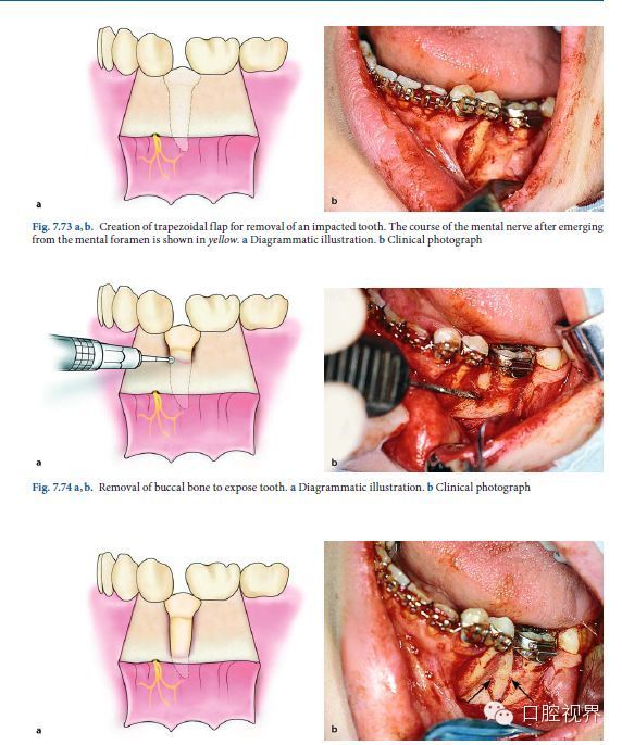 精美拔牙圖譜每位牙醫都要珍藏
