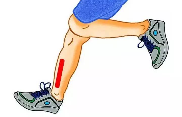 跑步时小腿前侧疼痛的必须看一下
