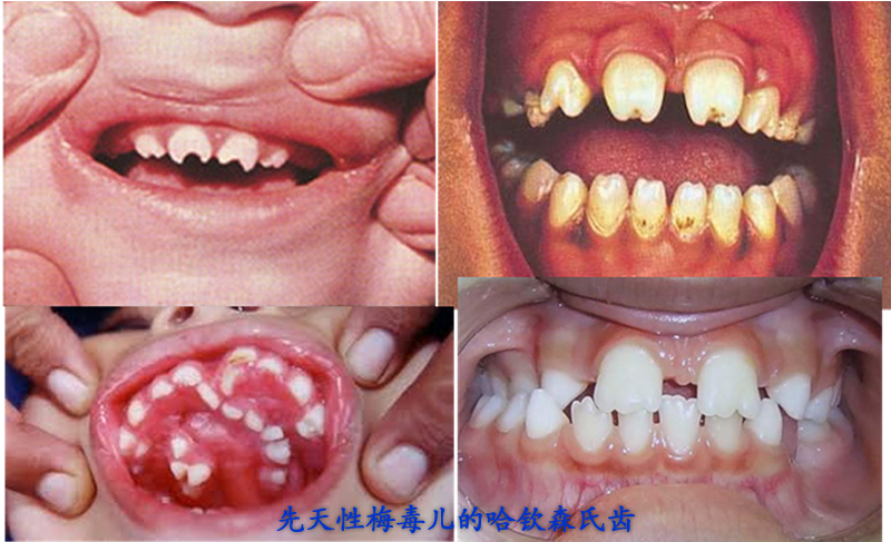 梅毒牙齿症状图片大全图片