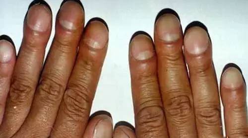 肺癌手指图片