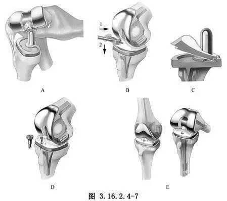 人工膝关节的种类图片图片