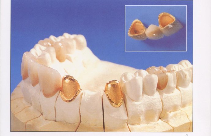 固定桥牙体预备图片