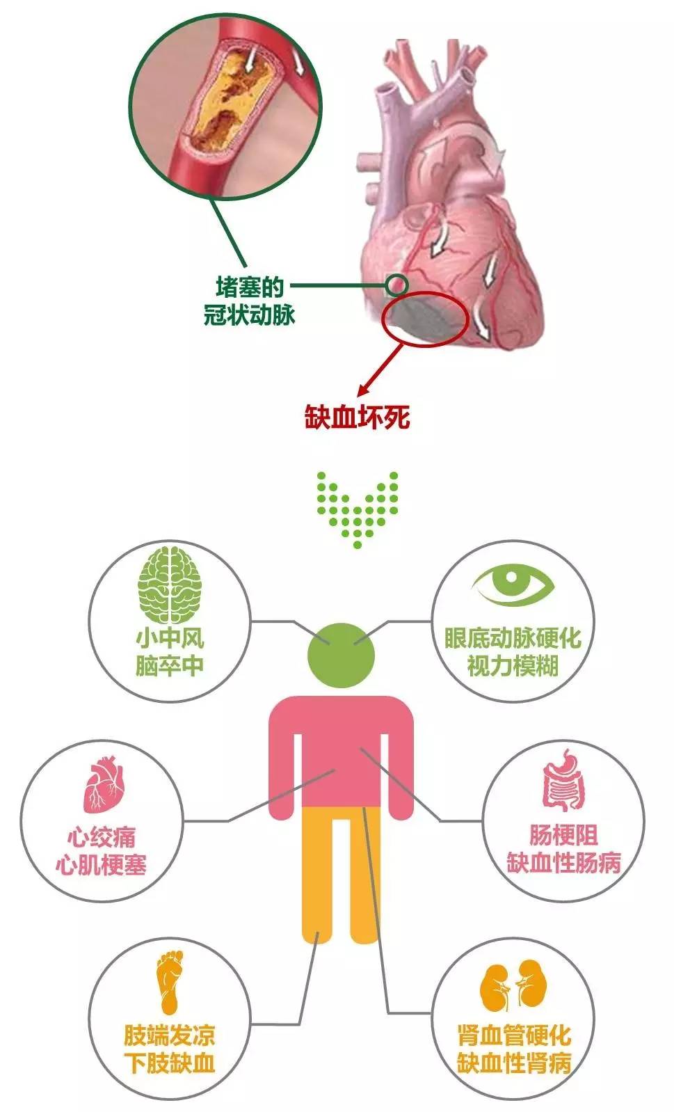 血管堵塞程度图片