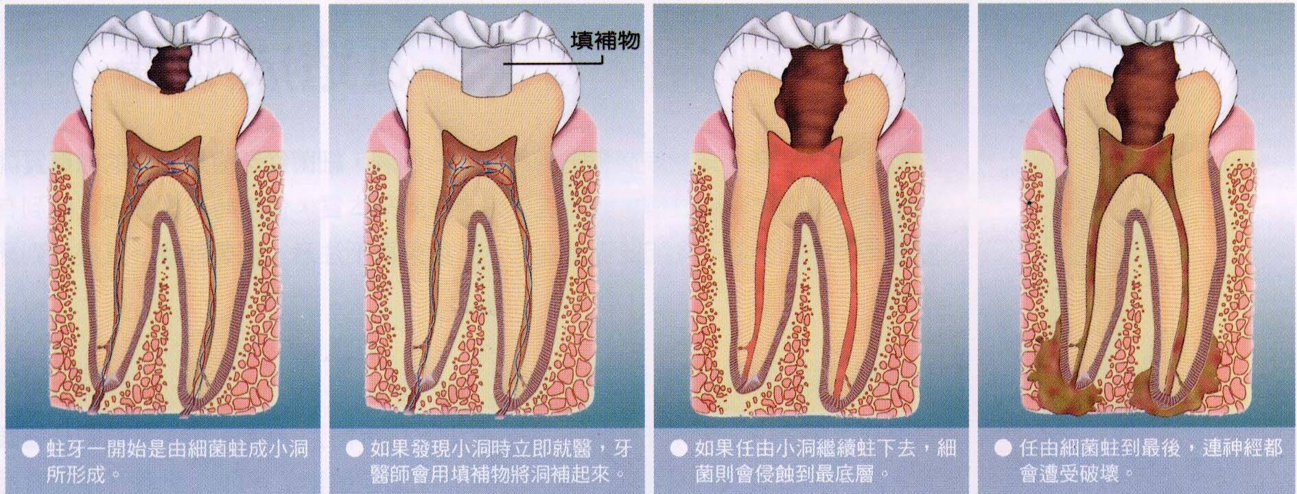 牙齒壞了,缺了,爛了,黑了,該拔該補?