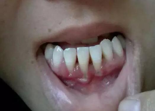 牙龈萎缩了还能治好吗?