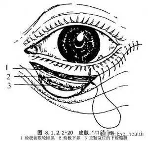 下睑内翻手术做法图解图片