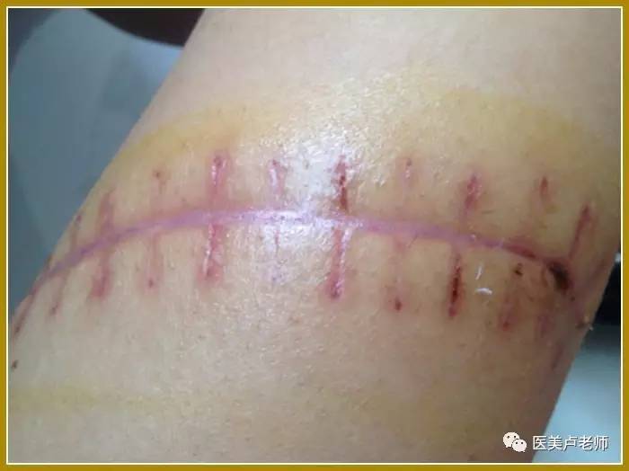 疤痕贴什么时候贴最好_疤痕贴和疤痕膏的区别_drkegel疤痕贴