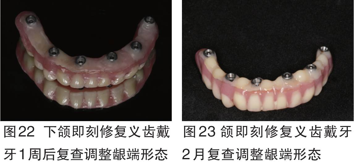 【2016bitc银奖病例】全口无牙颌种植固定修复一例