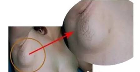 乳腺增生酒窝症状图图片