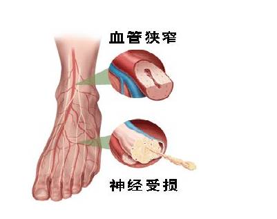 糖尿病慢性併發症知多少?