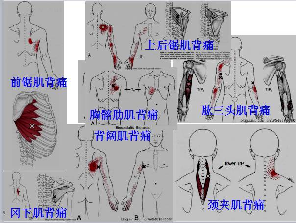 dorsi)肱二頭肌(biceps brachii)肱三頭肌(triceps brachii)頸夾