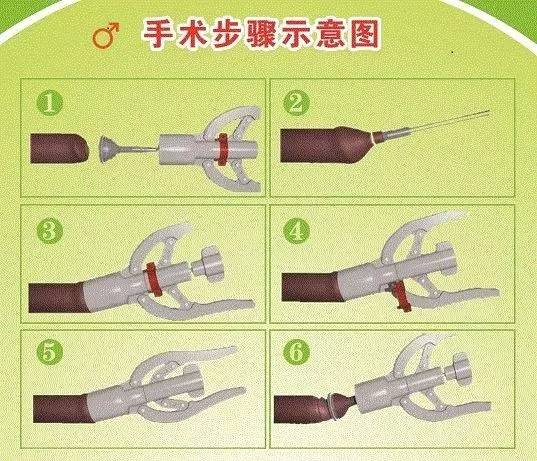 JJ切除示意图图片