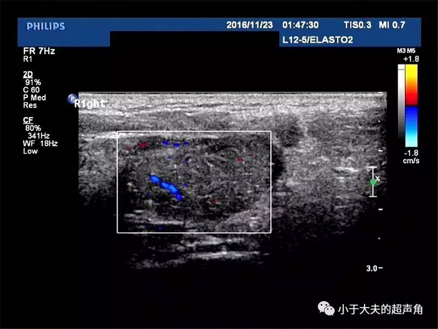 腹股沟疝气超声声像图图片