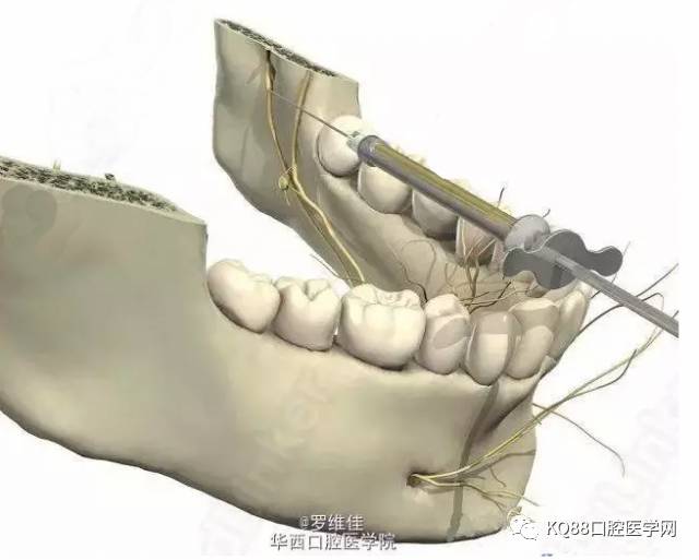 下牙槽阻滞麻醉图解图片