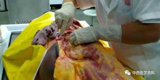 人体解剖手术 真实图片