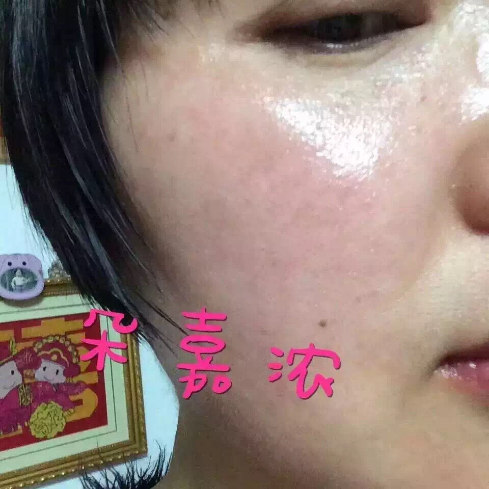 激素臉怎麼治療