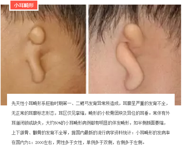 先天性小耳畸形患者的听力问题及治疗方法