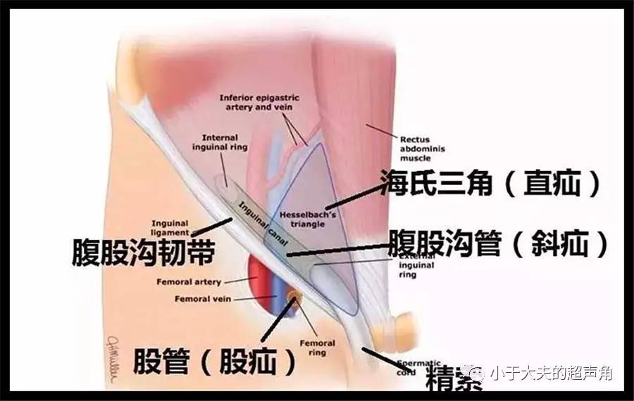 腹股沟疝气症状图片