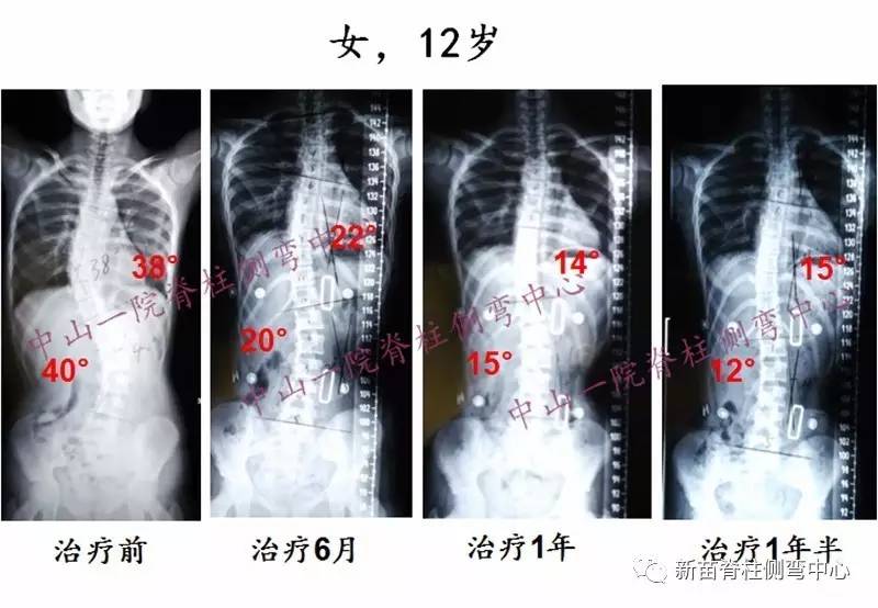 脊柱侧弯 50度