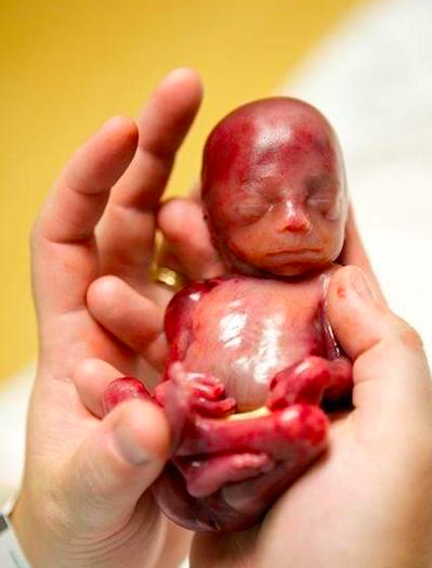 五个月胎儿人流下来图图片